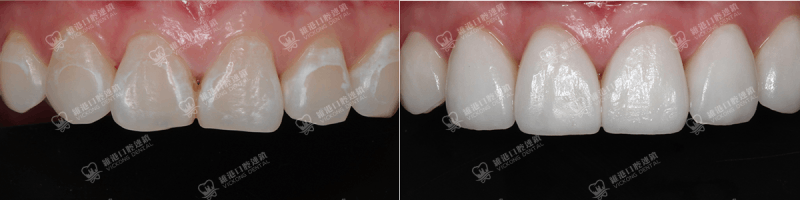 深圳種牙&深圳維港口腔